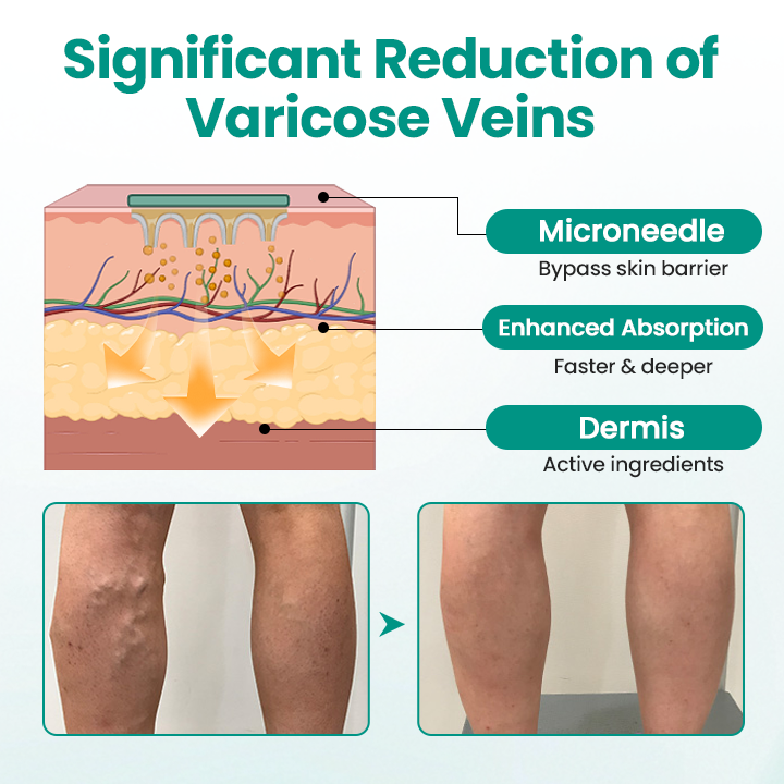 LegRenew Varicose Veins Microneedle Patch