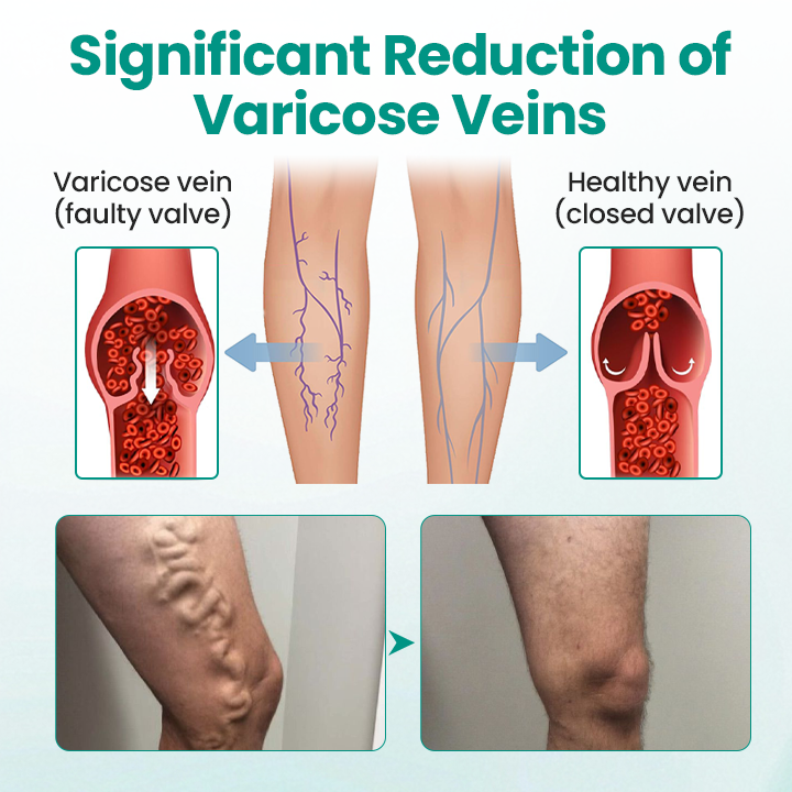 LegRenew Varicose Veins Microneedle Patch