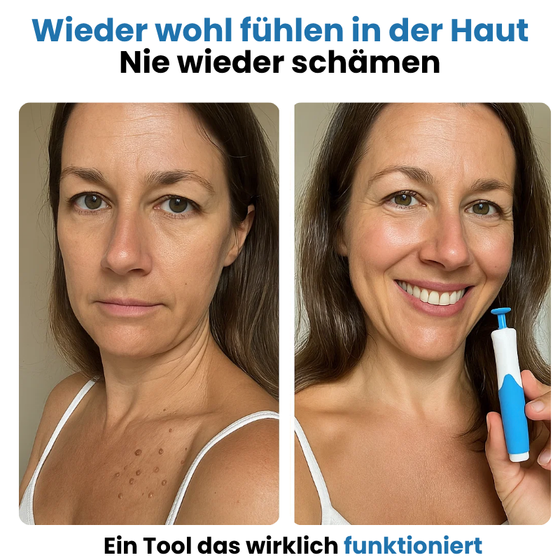 🔥LAST DAY 50% OFF⚡Skin Tag Remover - Skin Tag and Mole Remover for Home Use