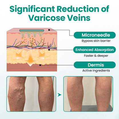 LegRenew Varicose Veins Microneedle Patch